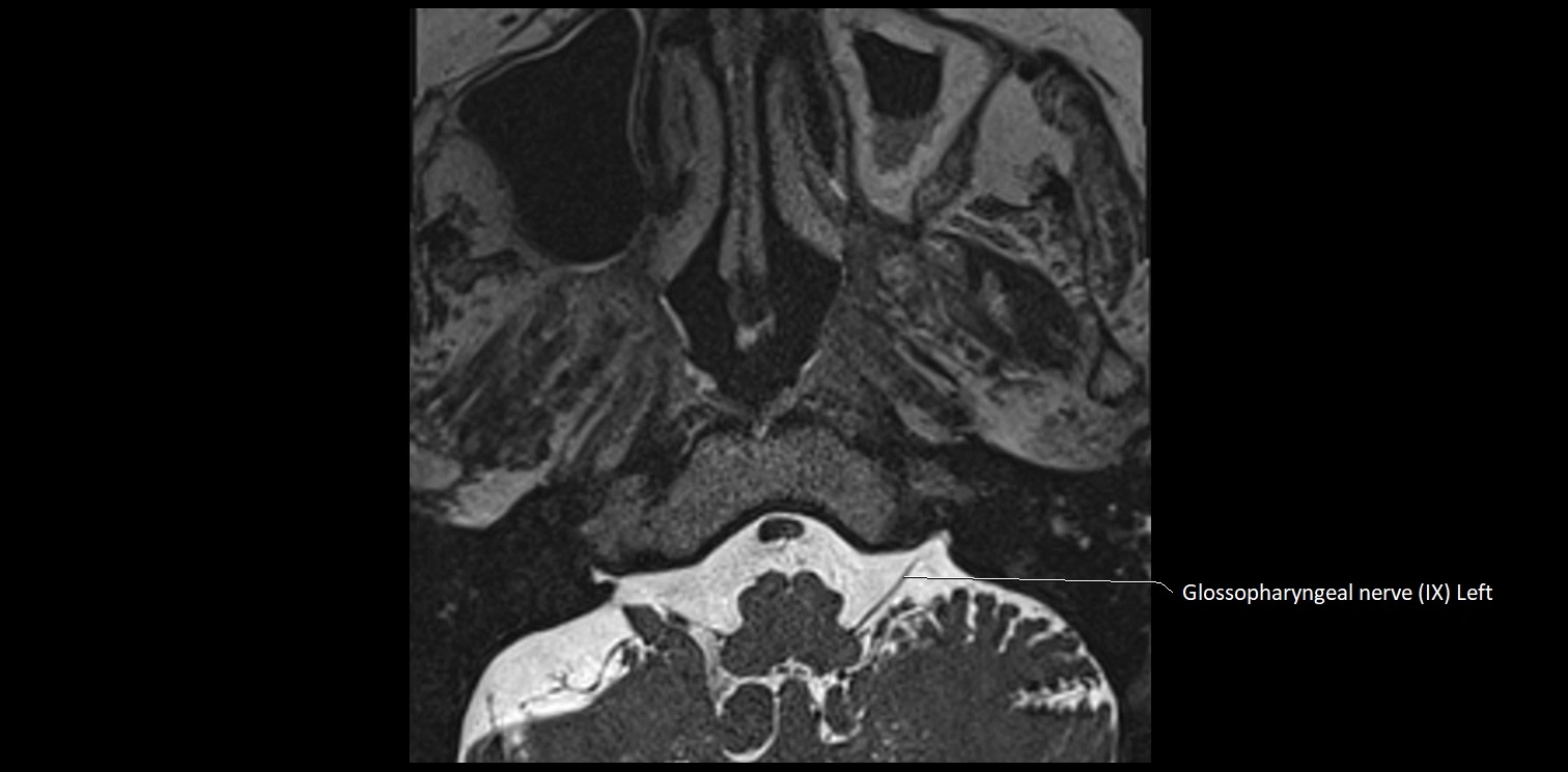 Cranial nerve anatomy axial MRI 3T image 68.webp